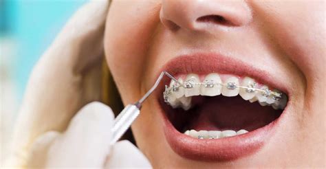 orthodontic bracket strength